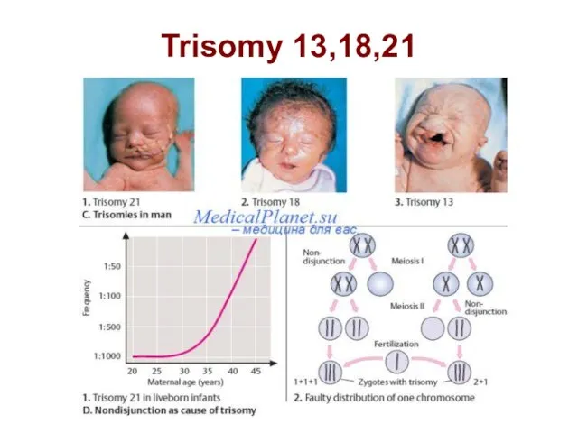 Trisomy 13,18,21