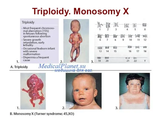 Triploidy. Monosomy X