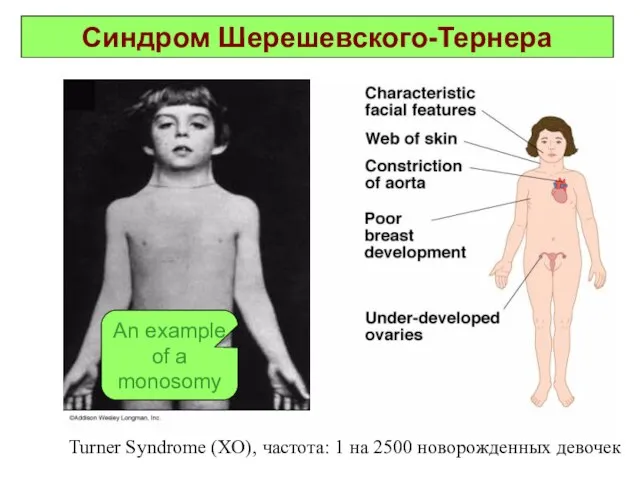 Синдром Шерешевского-Тернера Turner Syndrome (XO), частота: 1 на 2500 новорожденных девочек An example of a monosomy