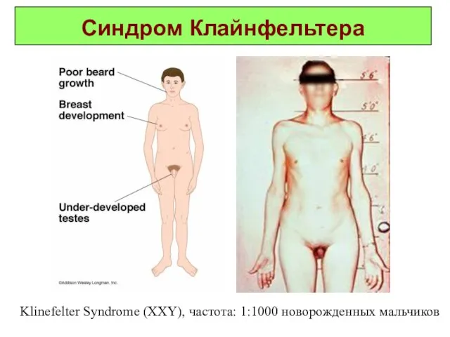 Синдром Клайнфельтера Klinefelter Syndrome (XXY), частота: 1:1000 новорожденных мальчиков