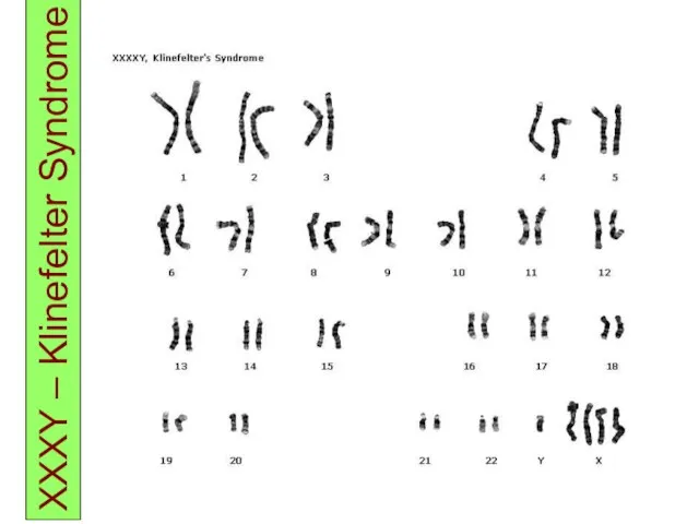 XXXY – Klinefelter Syndrome