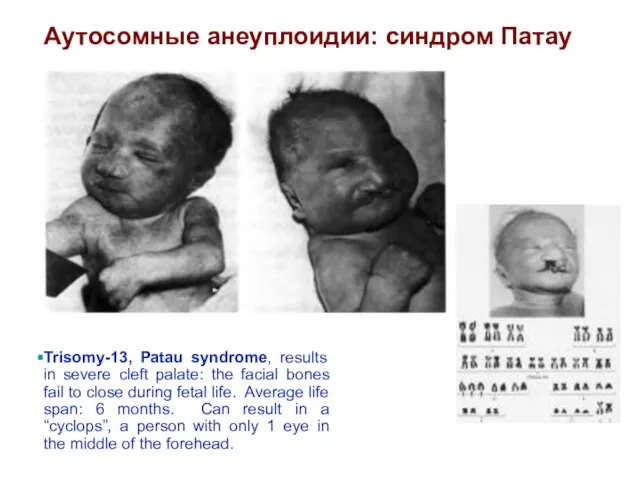 Trisomy-13, Patau syndrome, results in severe cleft palate: the facial bones