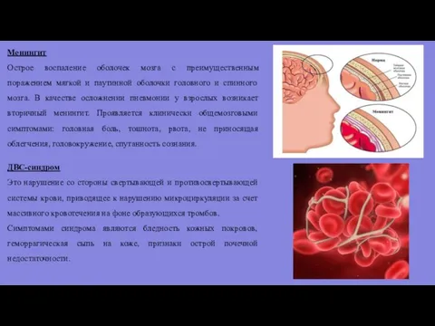 Менингит Острое воспаление оболочек мозга с преимущественным поражением мягкой и паутинной