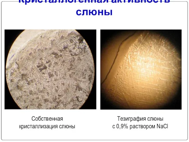 Кристаллогенная активность слюны Собственная кристаллизация слюны Тезиграфия слюны с 0,9% раствором NaCl