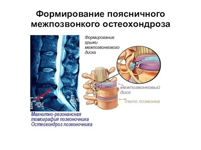 Формирование поясничного межпозвонкого остеохондроза