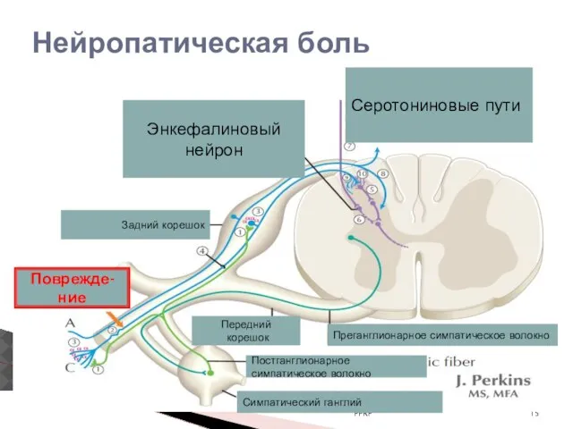 Нейропатическая боль PPRP Поврежде-ние Задний корешок Передний корешок Энкефалиновый нейрон Серотониновые