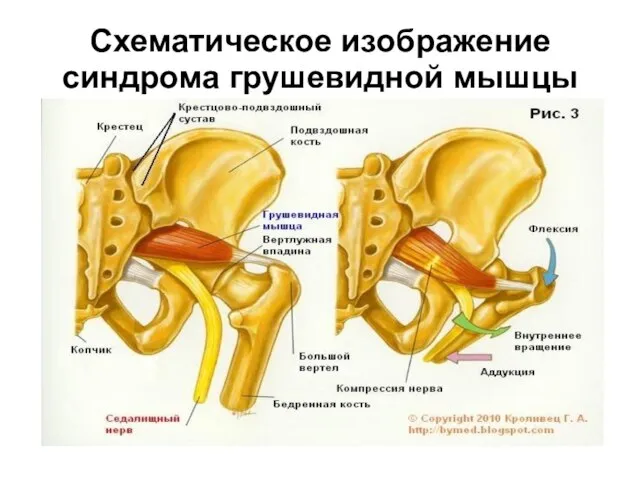 Схематическое изображение синдрома грушевидной мышцы