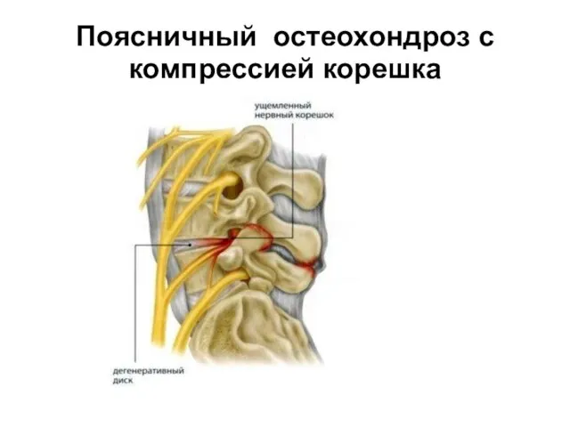 Поясничный остеохондроз с компрессией корешка