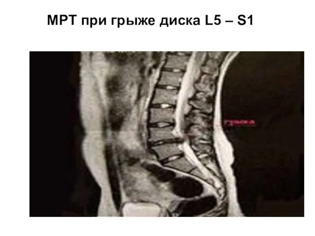 МРТ при грыже диска L5 – S1