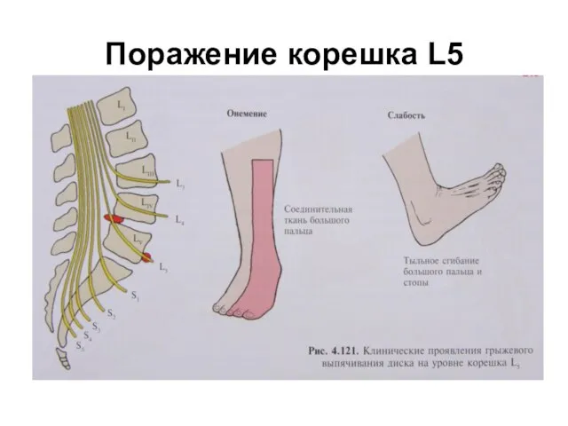 Поражение корешка L5