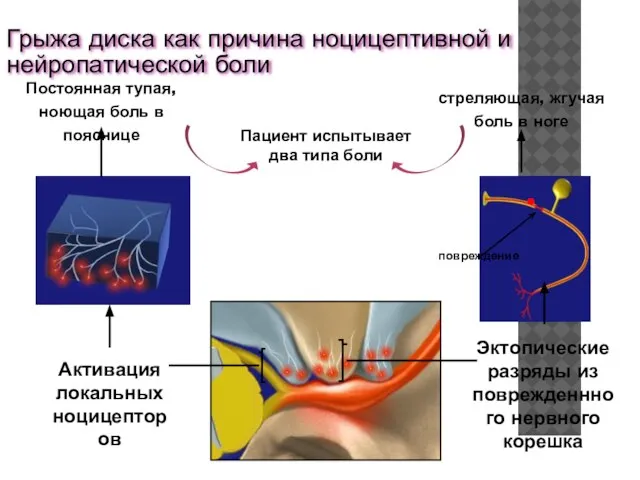 Грыжа диска как причина ноцицептивной и нейропатической боли