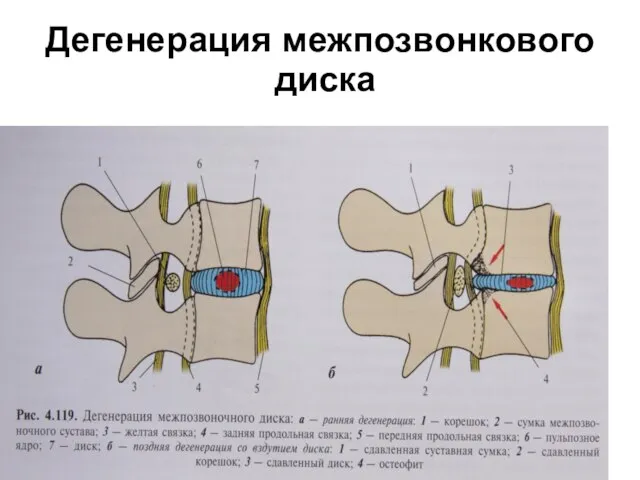 Дегенерация межпозвонкового диска