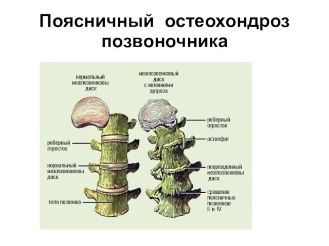 Поясничный остеохондроз позвоночника