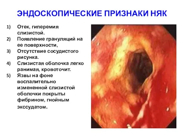 ЭНДОСКОПИЧЕСКИЕ ПРИЗНАКИ НЯК Отек, гиперемия слизистой. Появление грануляций на ее поверхности,