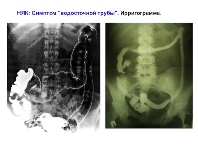 НЯК: Симптом "водосточной трубы". Ирригограмма.
