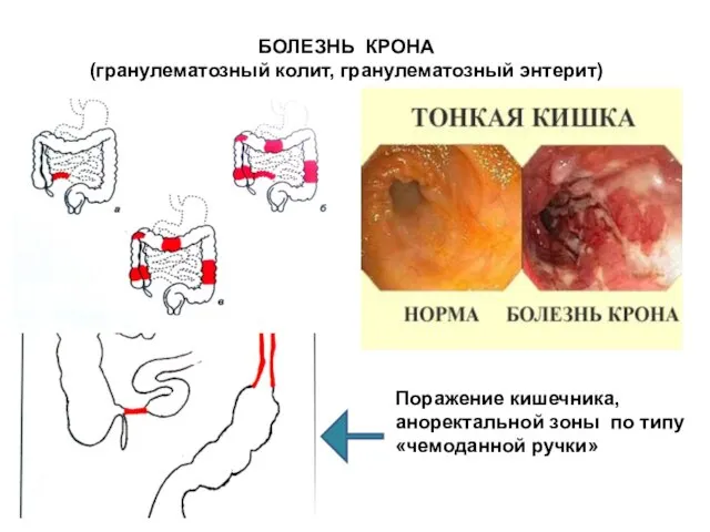 БОЛЕЗНЬ КРОНА (гранулематозный колит, гранулематозный энтерит) Поражение кишечника, аноректальной зоны по типу «чемоданной ручки»