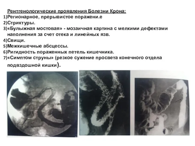 Рентгенологические проявления Болезни Крона: Регионарное, прерывистое поражени.е Стриктуры. «Булыжная мостовая» -