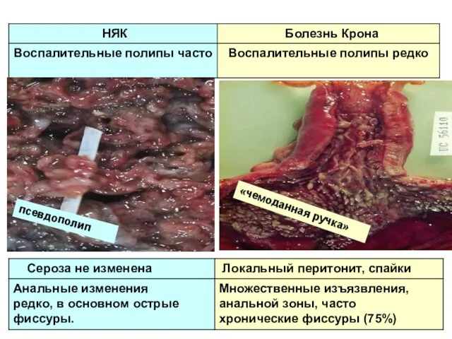 «чемоданная ручка» псевдополип