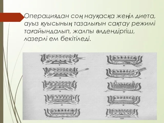 Операциядан соң науқасқа жеңіл диета, ауыз қуысының тазалығын сақтау режимі тағайындалып, жалпы әлдендіргіш, лазерлі ем бекітіледі.