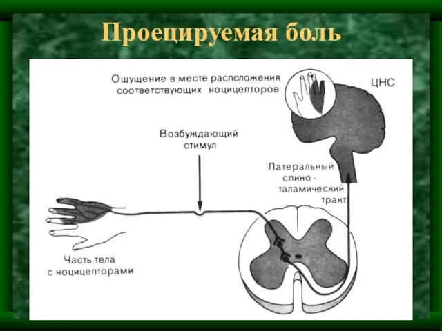 Проецируемая боль