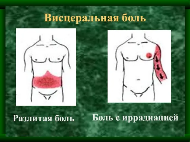 Висцеральная боль Разлитая боль Боль с иррадиацией