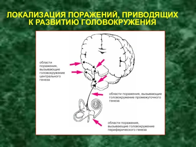 ЛОКАЛИЗАЦИЯ ПОРАЖЕНИЙ, ПРИВОДЯЩИХ К РАЗВИТИЮ ГОЛОВОКРУЖЕНИЯ