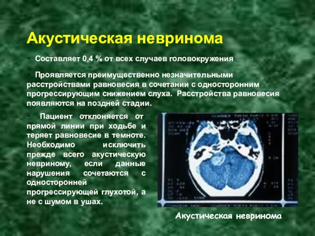 • Составляет 0,4 % от всех случаев головокружения • Пациент отклоняется