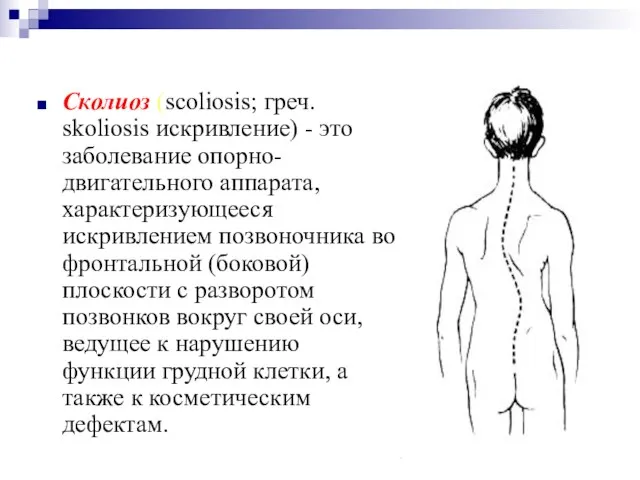 Сколиоз (scoliosis; греч. skoliosis искривление) - это заболевание опорно-двигательного аппарата, характеризующееся