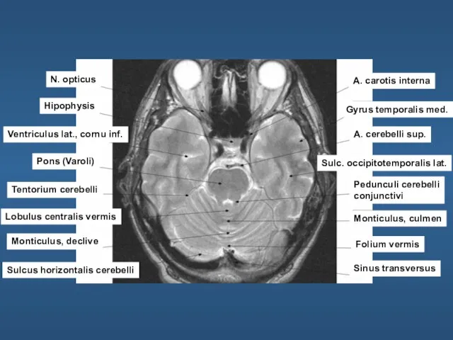 N. opticus Hipophysis Ventriculus lat., cornu inf. Pons (Varoli) Tentorium cerebelli