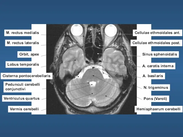 M. rectus medialis M. rectus lateralis Orbit, apex Lobus temporalis Cisterna