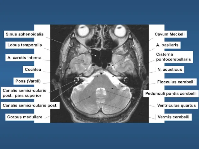 Sinus sphenoidalis Lobus temporalis A. carotis interna Cochlea Pons (Varoli) Canalis