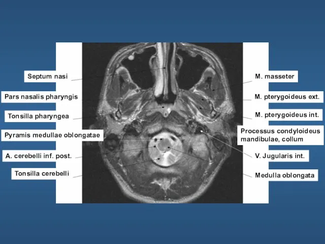 Septum nasi Pars nasalis pharyngis Tonsilla pharyngea Pyramis medullae oblongatae A.