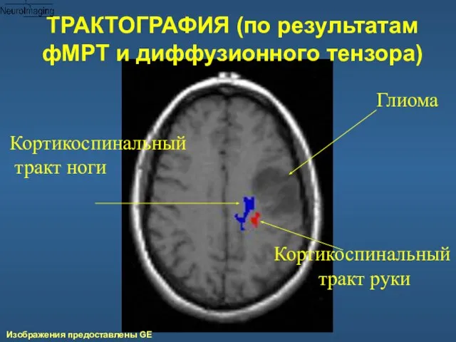 Глиома Кортикоспинальный тракт руки Кортикоспинальный тракт ноги ТРАКТОГРАФИЯ (по результатам фМРТ