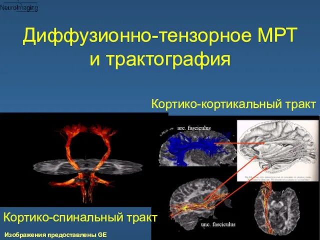 Диффузионно-тензорное МРТ и трактография Кортико-спинальный тракт Кортико-кортикальный тракт Изображения предоставлены GE