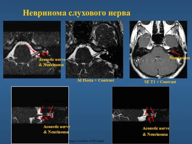 Невринома слухового нерва Acoustic nerve & Neurinoma Facial nerve Neurinoma SE