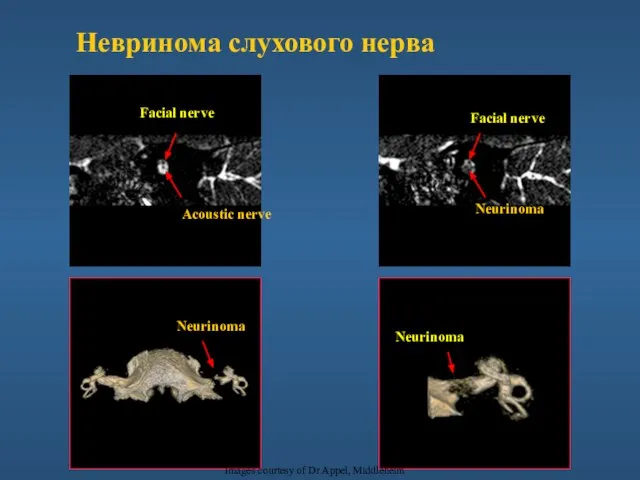 Neurinoma Facial nerve Facial nerve Acoustic nerve Neurinoma Neurinoma Images courtesy