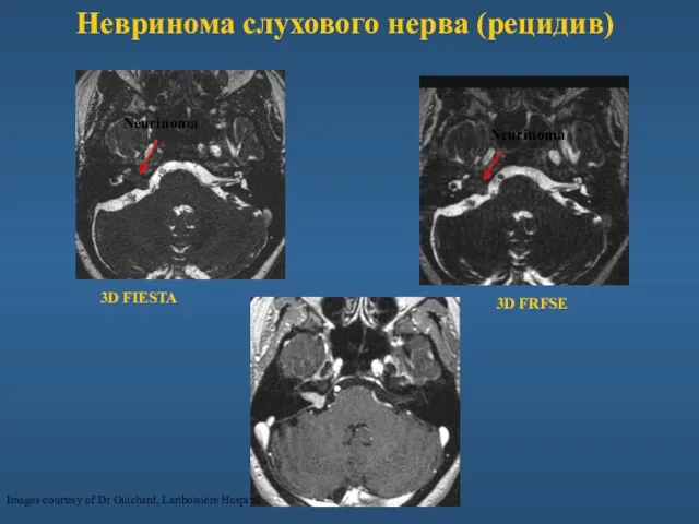 Невринома слухового нерва (рецидив) Images courtesy of Dr Guichard, Lariboisiere Hospital