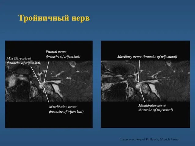 Trijeminal nerve Maxillary nerve (branche of trijeminal) Mandibular nerve (branche of