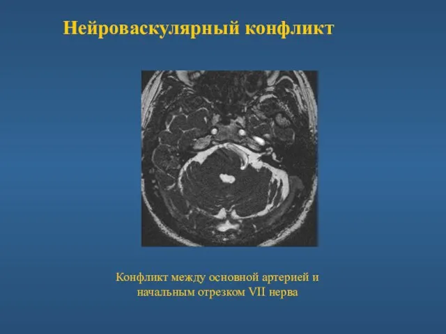 Конфликт между основной артерией и начальным отрезком VII нерва Нейроваскулярный конфликт