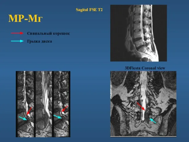 МР-Мг 3DFiesta Coronal view Sagital FSE T2 Спинальный корешок Грыжа диска