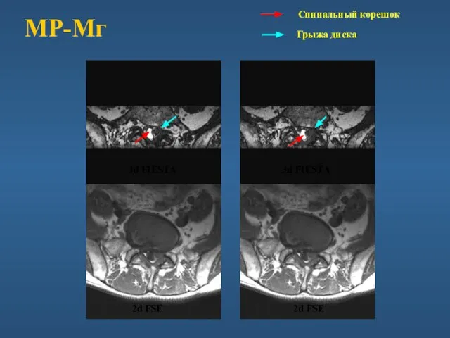 Спинальный корешок 3d FIESTA 3d FIESTA 2d FSE 2d FSE МР-Мг Грыжа диска