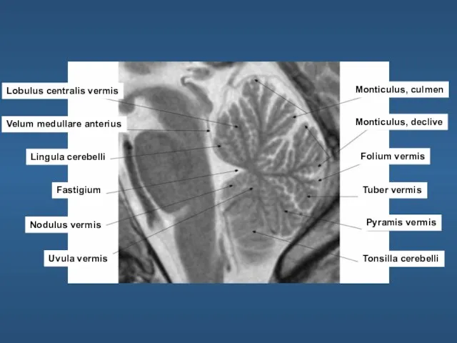 Lobulus centralis vermis Velum medullare anterius Lingula cerebelli Fastigium Nodulus vermis