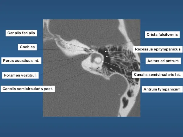 Canalis facialis Cochlea Porus acusticus int. Foramen vestibuli Canalis semicircularis post.