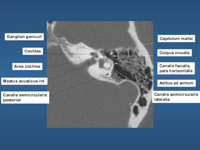 Ganglion geniculi Cochlea Area cochlea Meatus acusticus int. Canalis semicircularis posterior