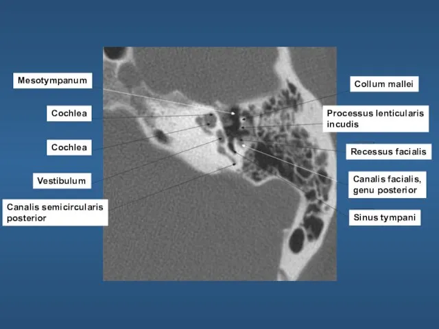 Mesotympanum Cochlea Cochlea Vestibulum Canalis semicircularis posterior Collum mallei Processus lenticularis