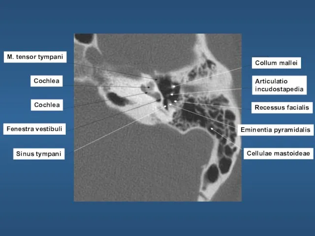 M. tensor tympani Cochlea Cochlea Fenestra vestibuli Sinus tympani Collum mallei