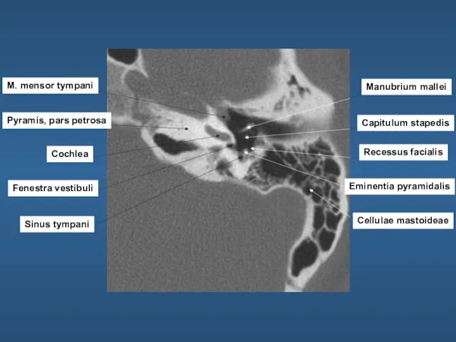 M. mensor tympani Pyramis, pars petrosa Cochlea Fenestra vestibuli Sinus tympani