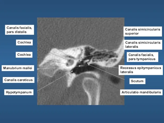 Canalis facialis, pars distalis Cochlea Cochlea Manubrium mallei Canalis caroticus Hypotympanum