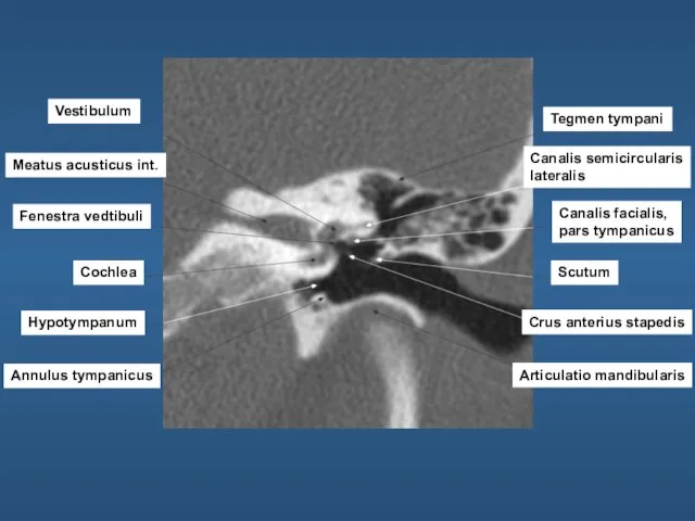 Vestibulum Meatus acusticus int. Fenestra vedtibuli Cochlea Hypotympanum Annulus tympanicus Tegmen