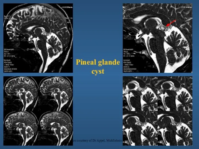 Pineal glande cyst Images courtesy of Dr Appel, Middleheim